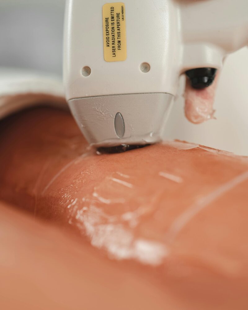 Medi Diode laser hair reduction treatment