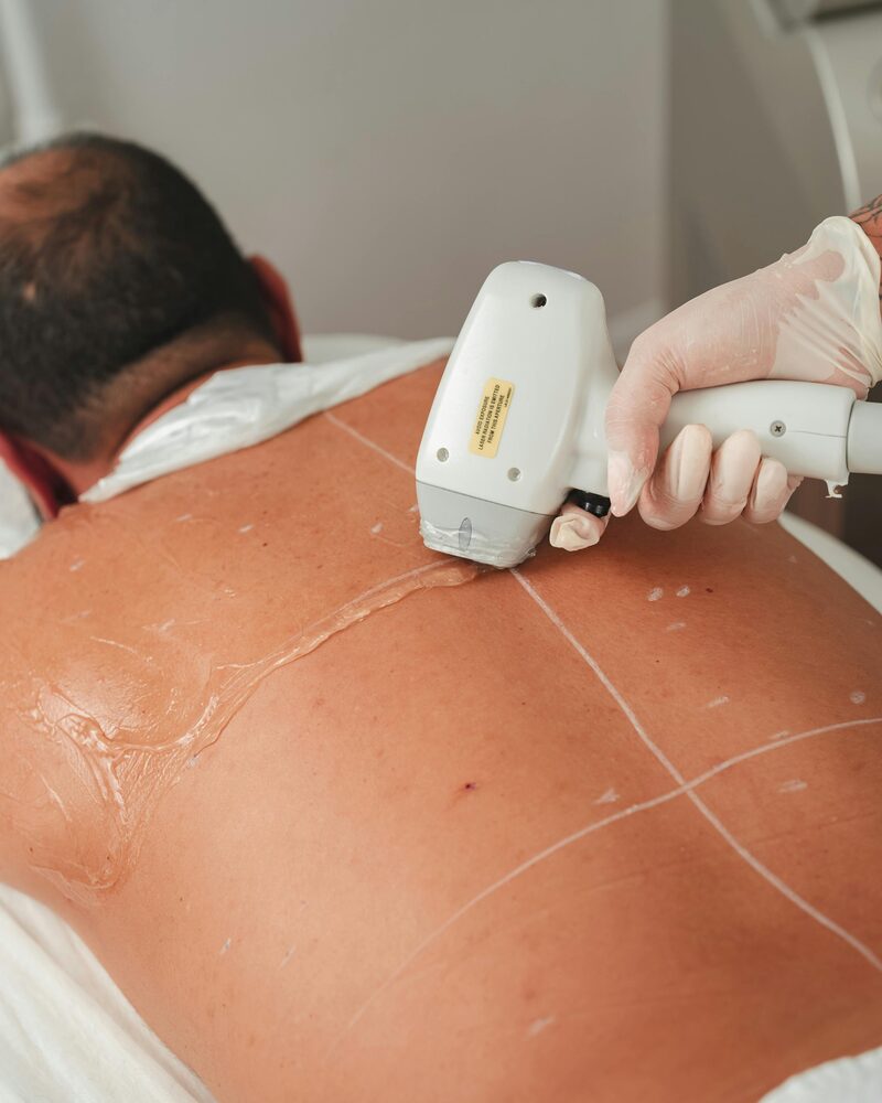 Laser hair reduction treatment at Rocky Mountain Skin in South Salt Lake, Utah