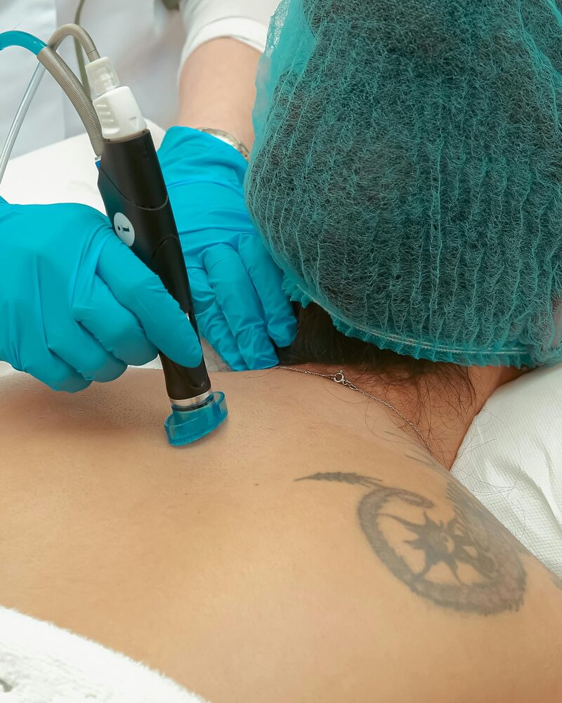 Laser tattoo removal treatment in progress